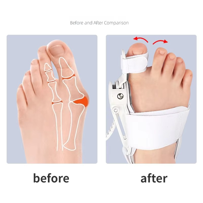 Hallux Valgus Bunion Corrector Toe Separator Foot Alignment Support