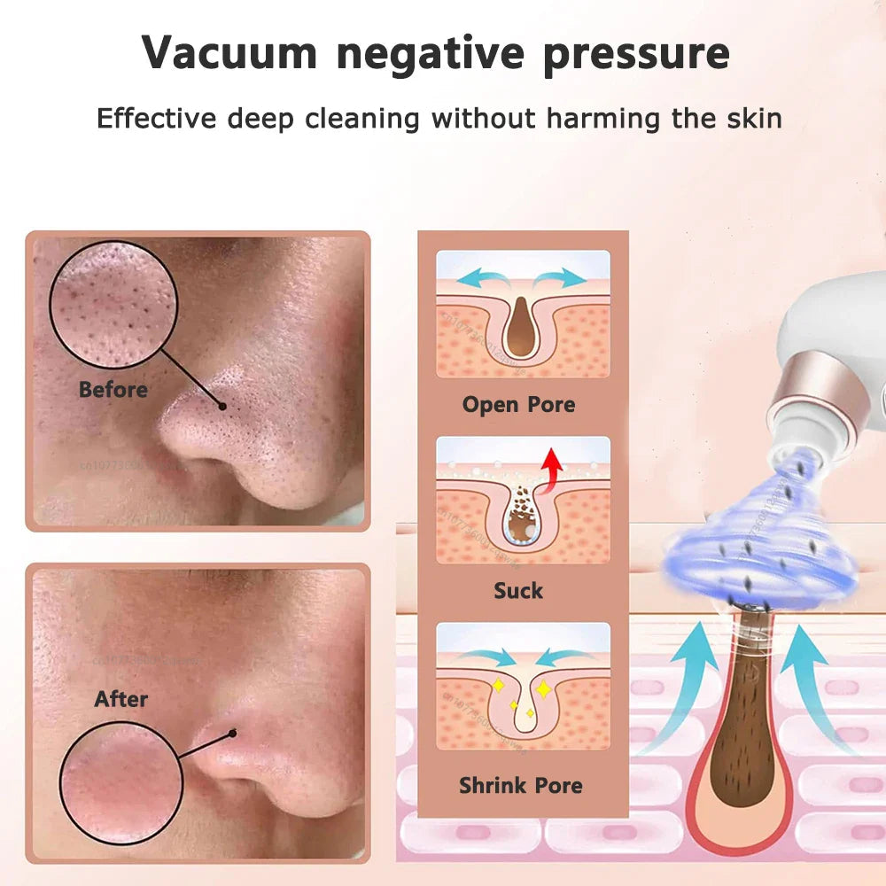 Acne Black Head Deep Clean Removal