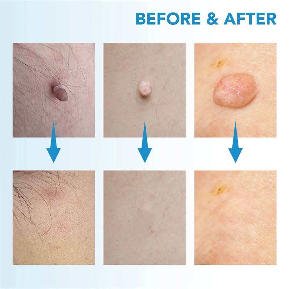 Skin spot remover for warts & skin tags