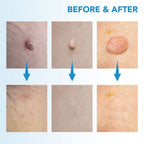 Skin spot remover for warts & skin tags