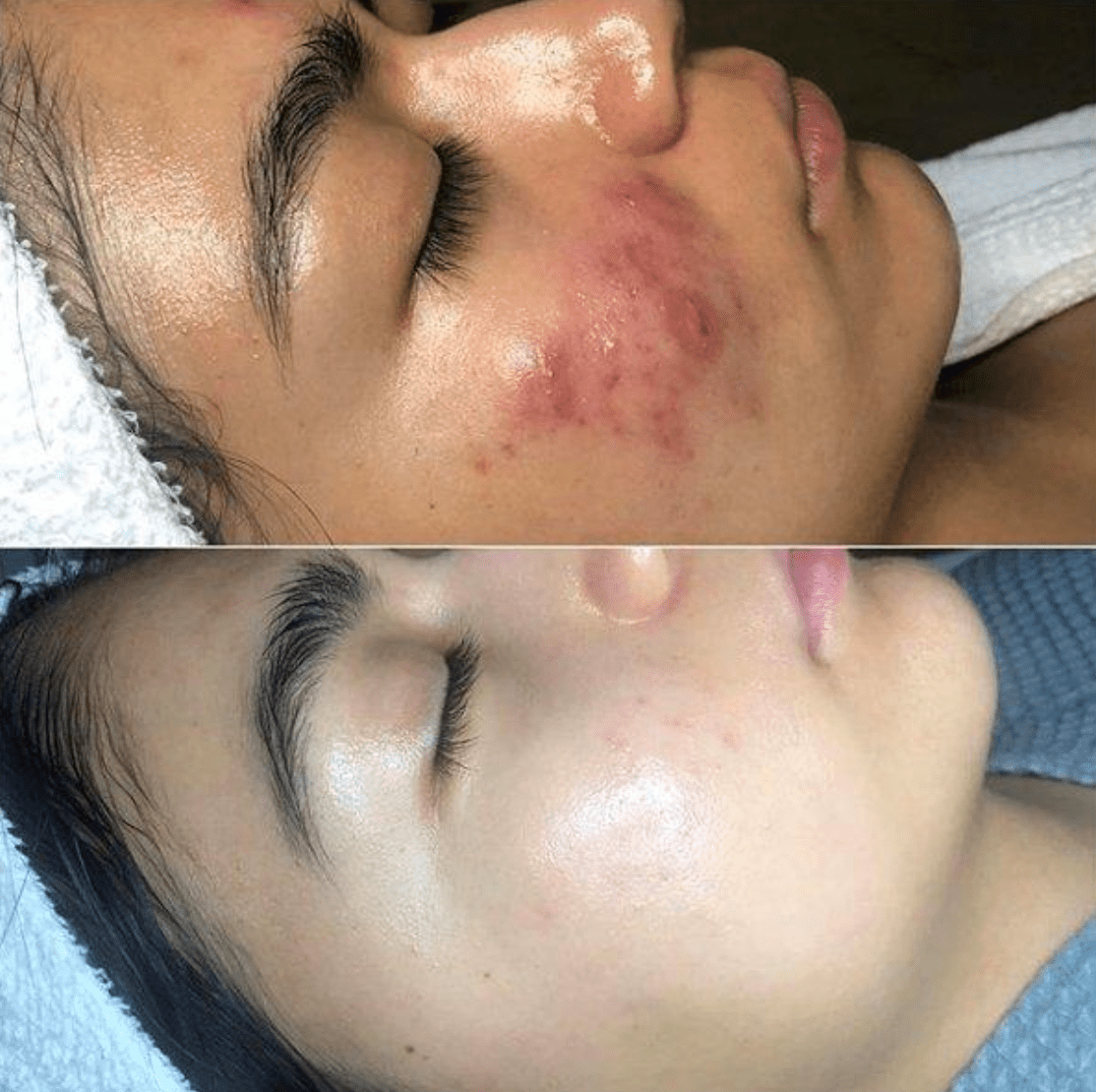 Frendorf High Frequency Skin Therapy
