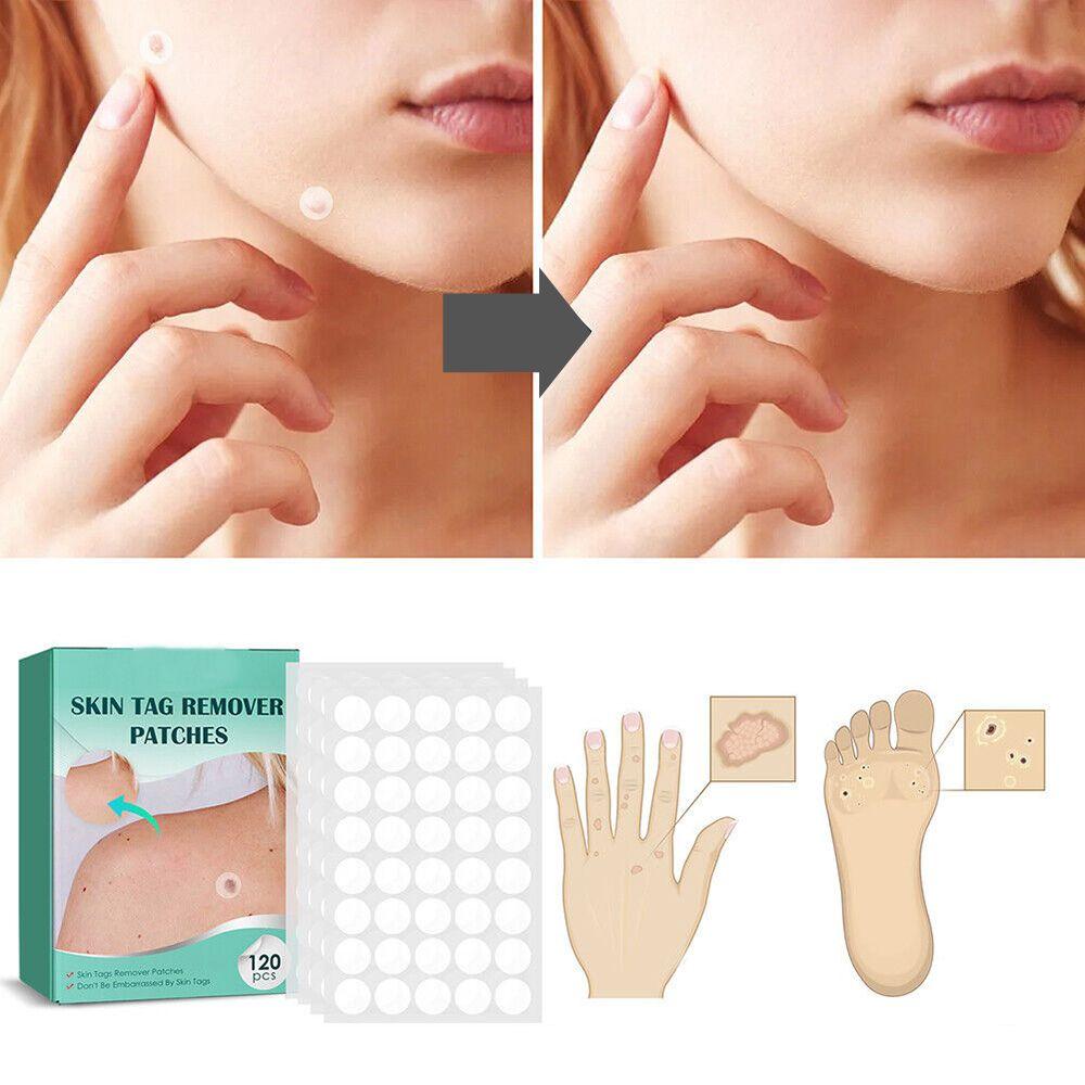 SkinClear - Plaster for the removal of spots and warts