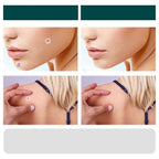 SkinClear - Plaster for the removal of spots and warts