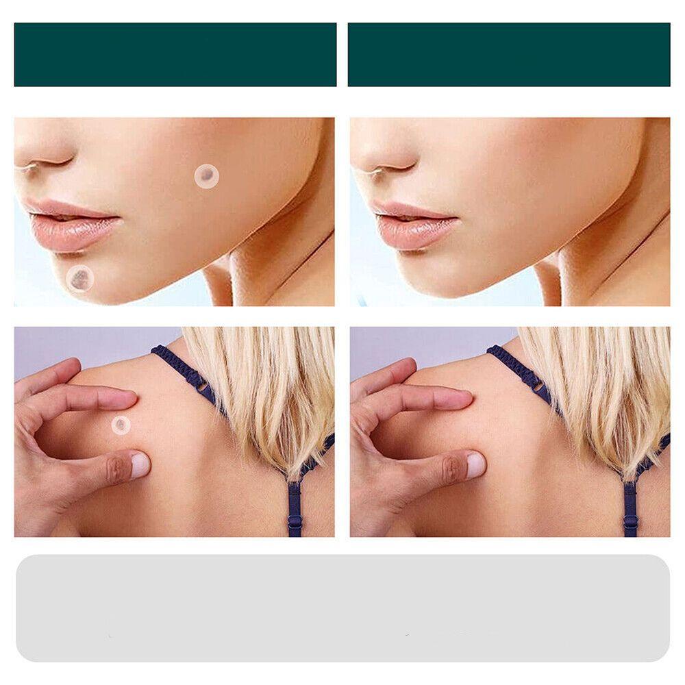 SkinClear - Plaster for the removal of spots and warts