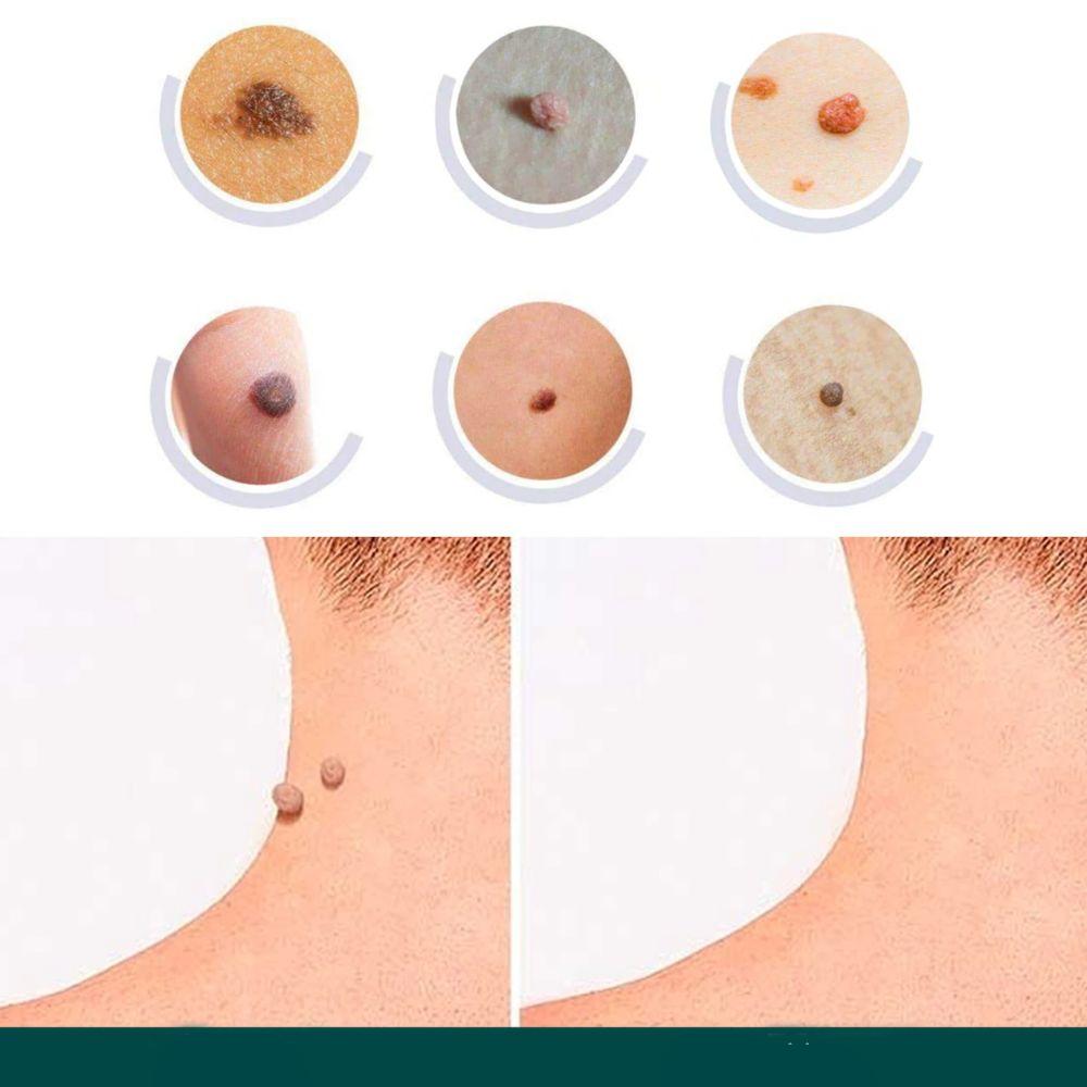 SkinClear - Plaster for the removal of spots and warts