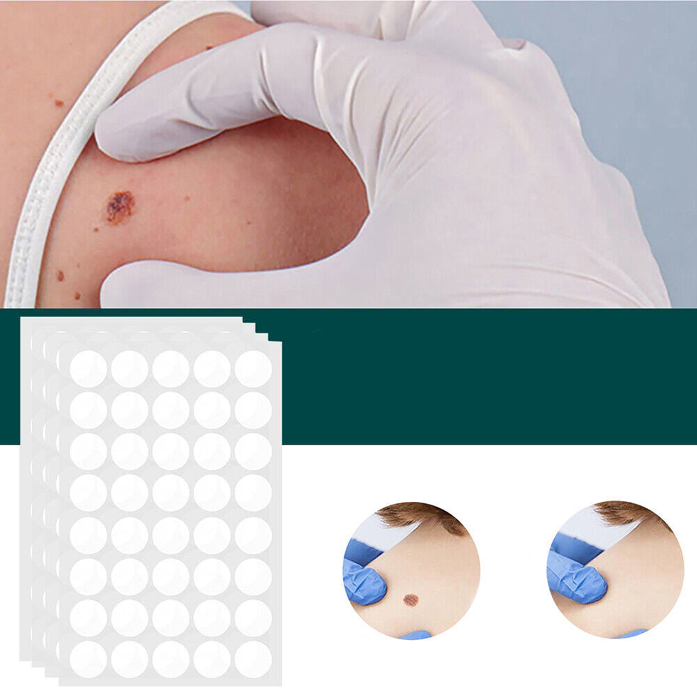 SkinClear - Plaster for the removal of spots and warts
