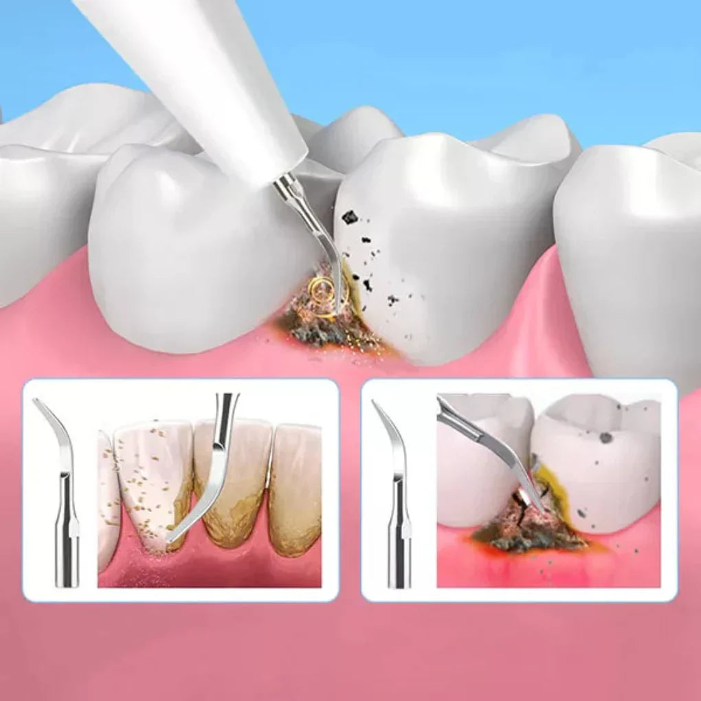 Ultrasonic Tooth Cleaning Pro – Electric Tartar Remover for Home Use