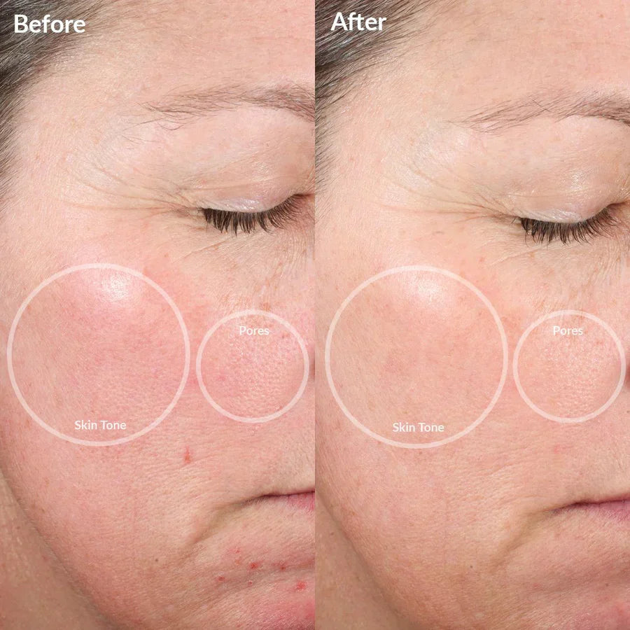 4-in-1 Lumi Lift - improve your skin in 2 days with LED and EMS light therapy
