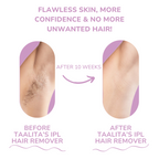 SoftLight IPL Hair Removal Device – Pain-Free Home Hair Removal