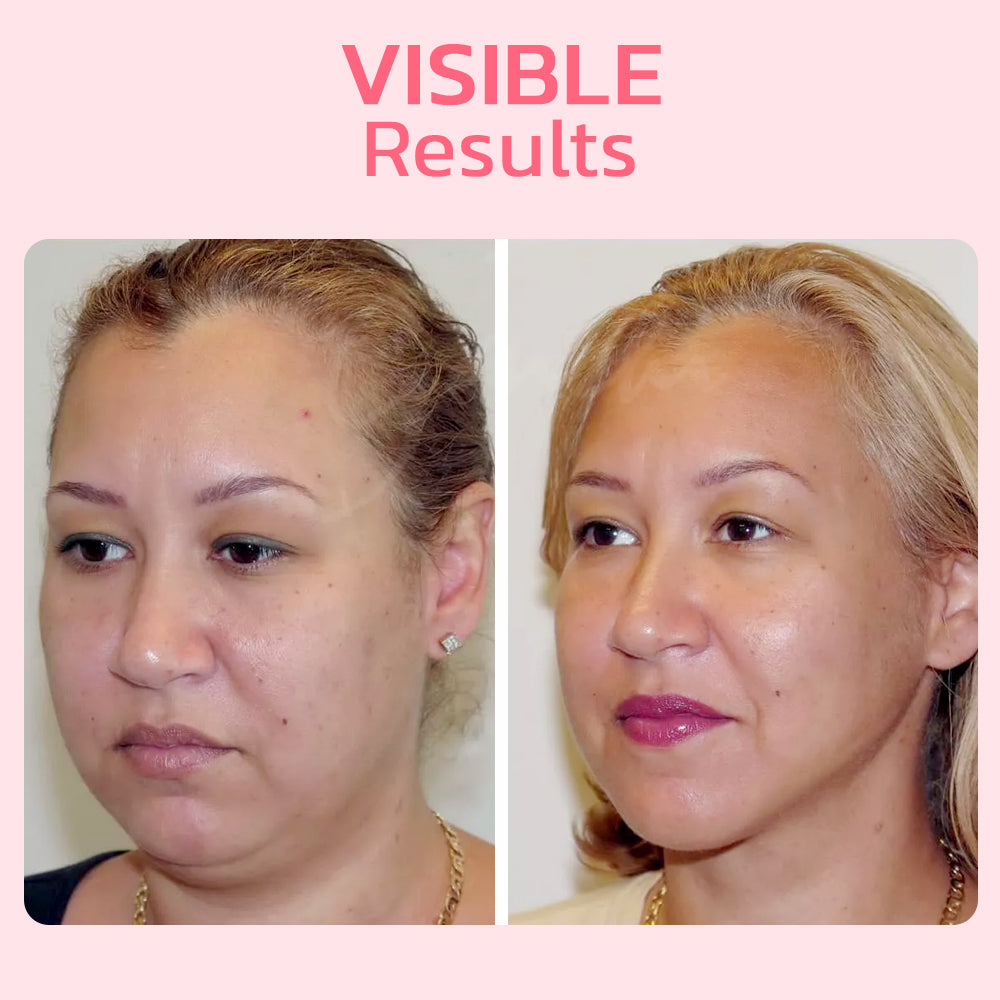 FaceSuction Enhanced Facial Definition