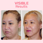 FaceSuction Enhanced Facial Definition