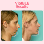 FaceSuction Enhanced Facial Definition