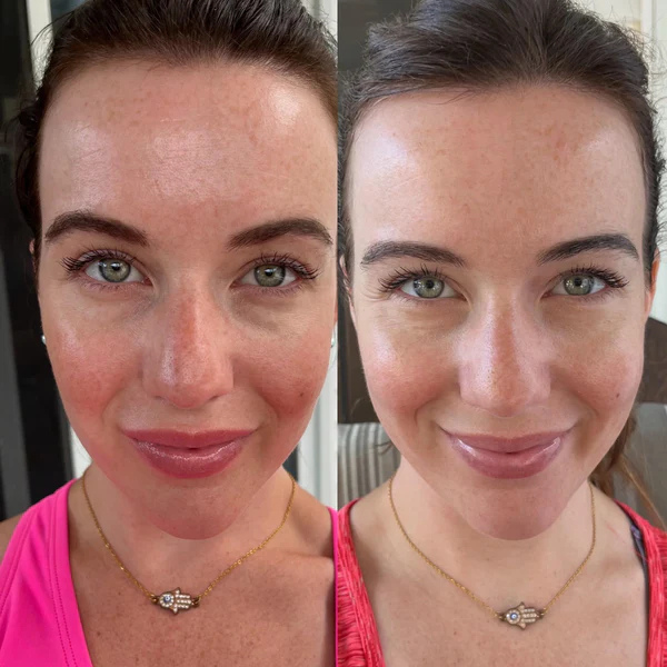 LumiGlow - Pain-Free Treatment: Non-Invasive Therapy