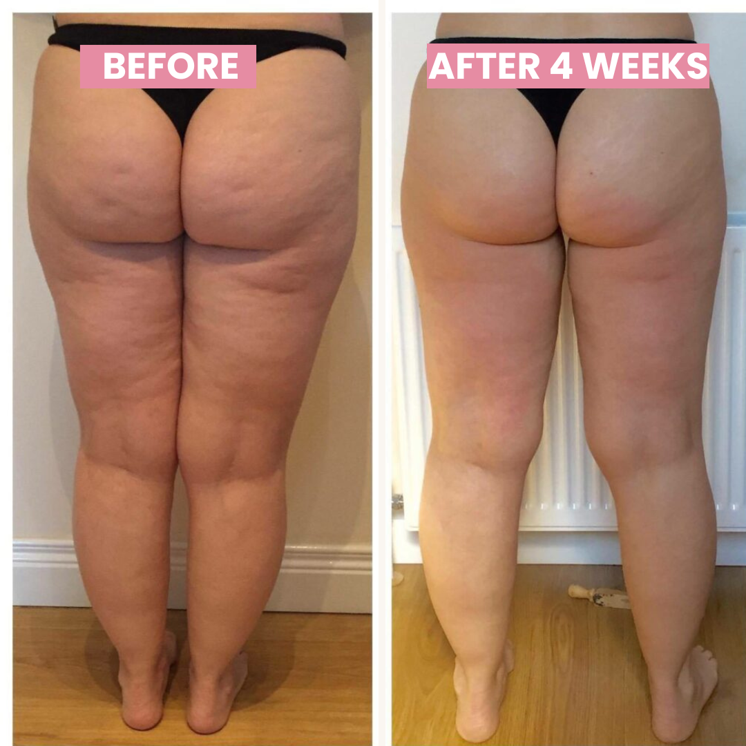 Anti-cellulite Cupping Device - SlimCupp