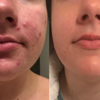 LumeniSkin — Put an end to blemishes and radiate confidence!