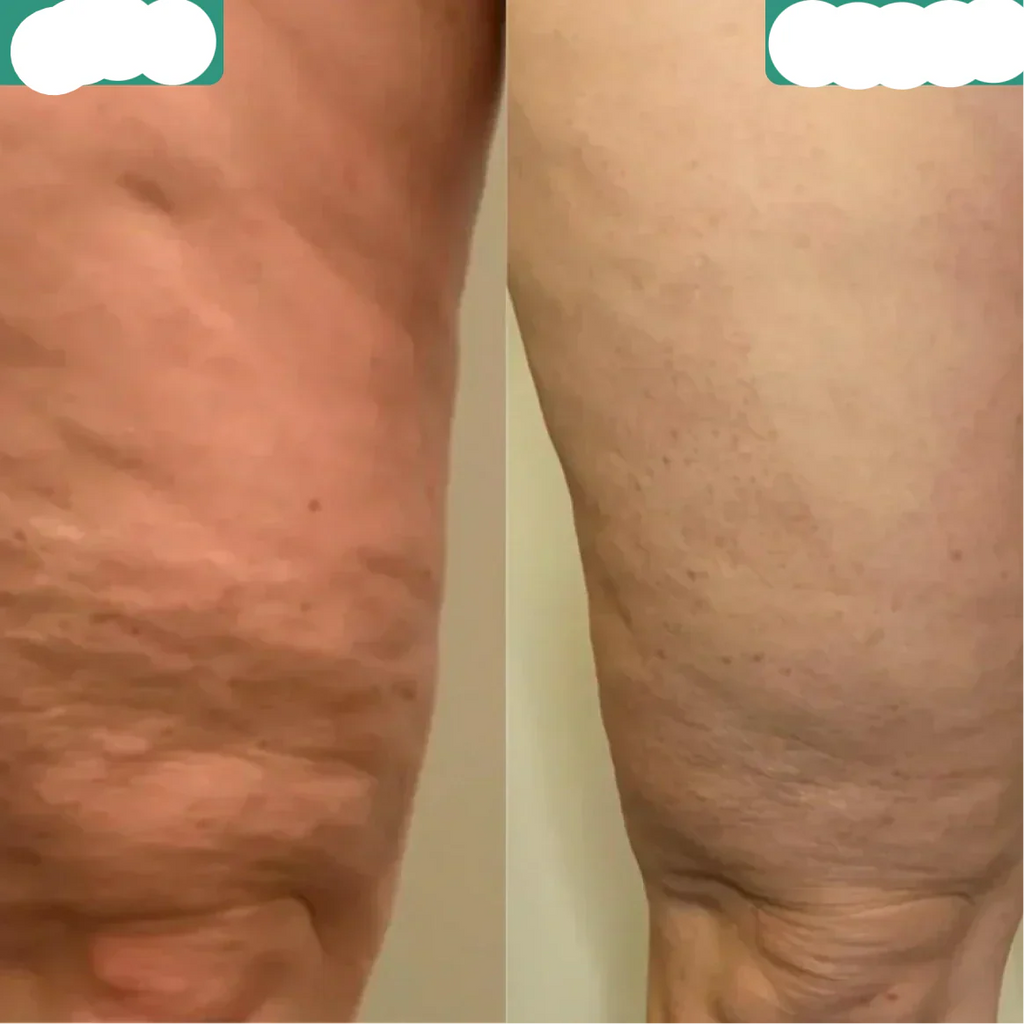 Effective Cellulite Reduction and Skin Smoothing