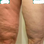 Effective Cellulite Reduction and Skin Smoothing