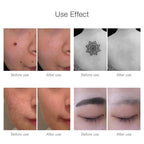 Laser Removal Pen for Dark Spots, Tattoos, Moles and Skin Tags