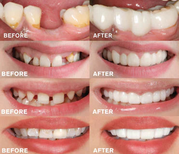 Snap-in Dental Prosthesis | 1+1 FREE!