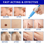 EPICLEAR – At-Home Skin Tag & Wart Remover Kit