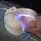 Nail therapy device | Home use, medication-free, nail fungus solution