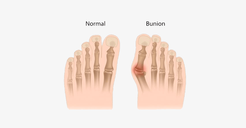 Comfort Healing Toe Separators and Hallux Valgus Spacers