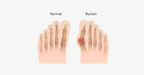 Comfort Healing Toe Separators and Hallux Valgus Spacers