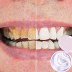 SmileSnap - Always the perfect smile with these veneers