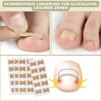 ALIGNSTRIP – Painless Nail Correction Strips for Ingrown & Deformed Nails