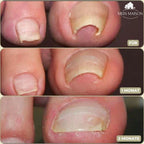 ALIGNSTRIP – Painless Nail Correction Strips for Ingrown & Deformed Nails