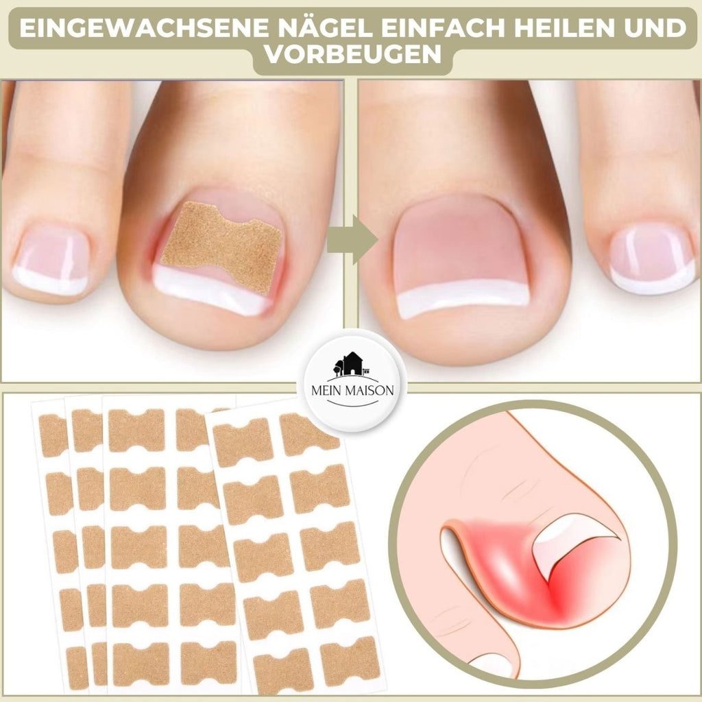 ALIGNSTRIP – Painless Nail Correction Strips for Ingrown & Deformed Nails