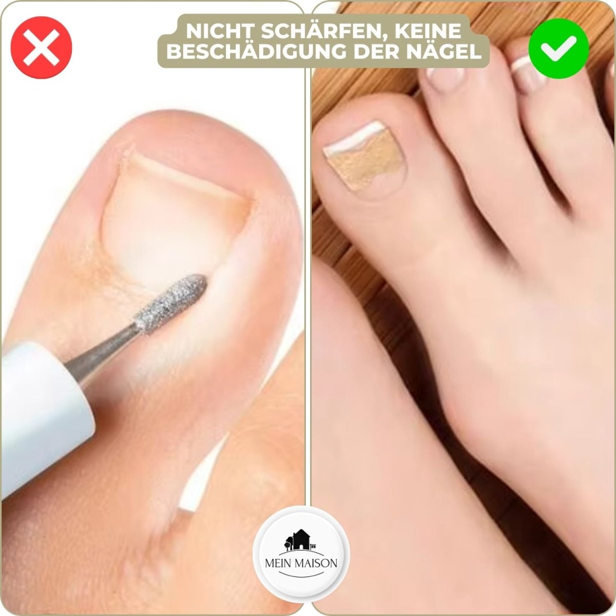 ALIGNSTRIP – Painless Nail Correction Strips for Ingrown & Deformed Nails