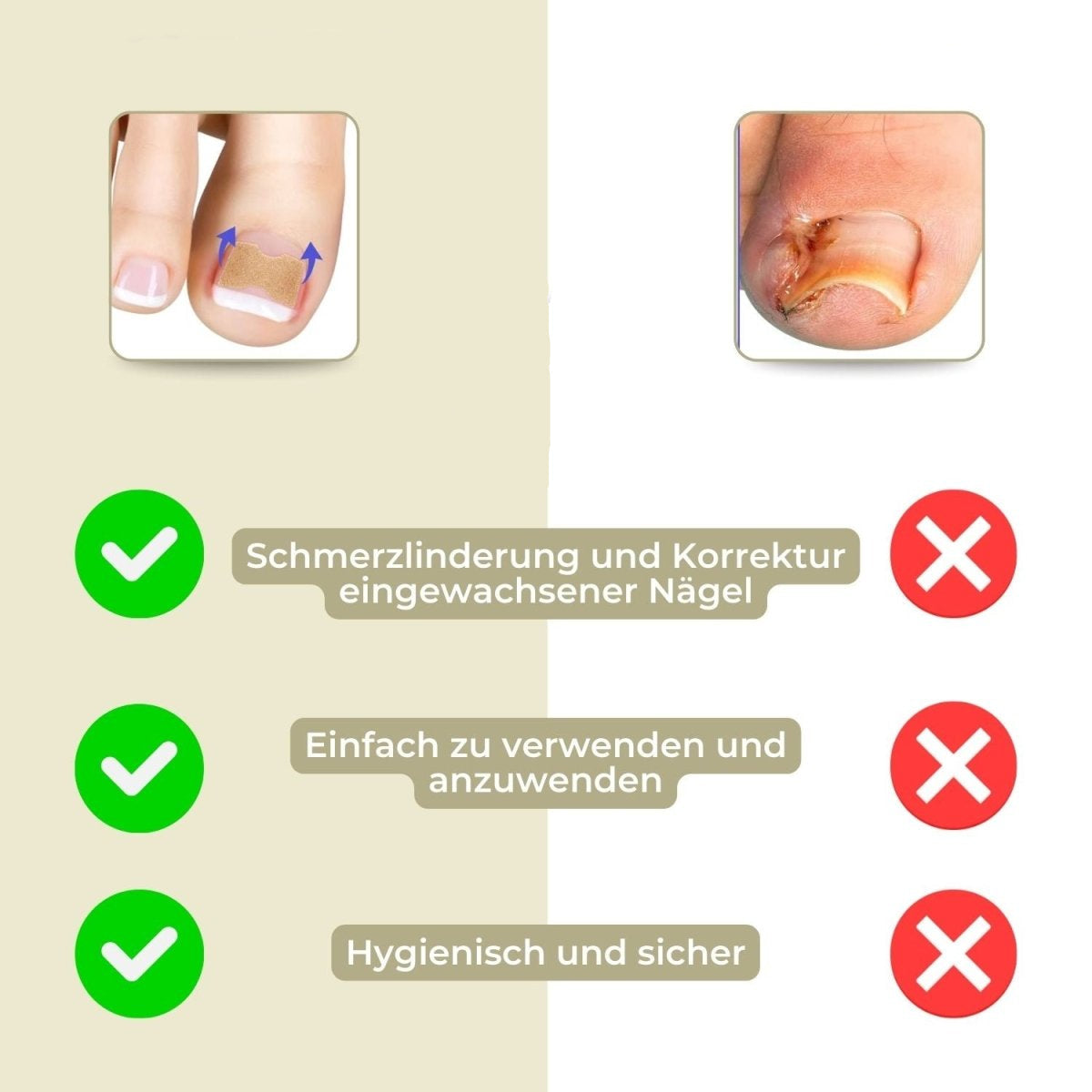 ALIGNSTRIP – Painless Nail Correction Strips for Ingrown & Deformed Nails