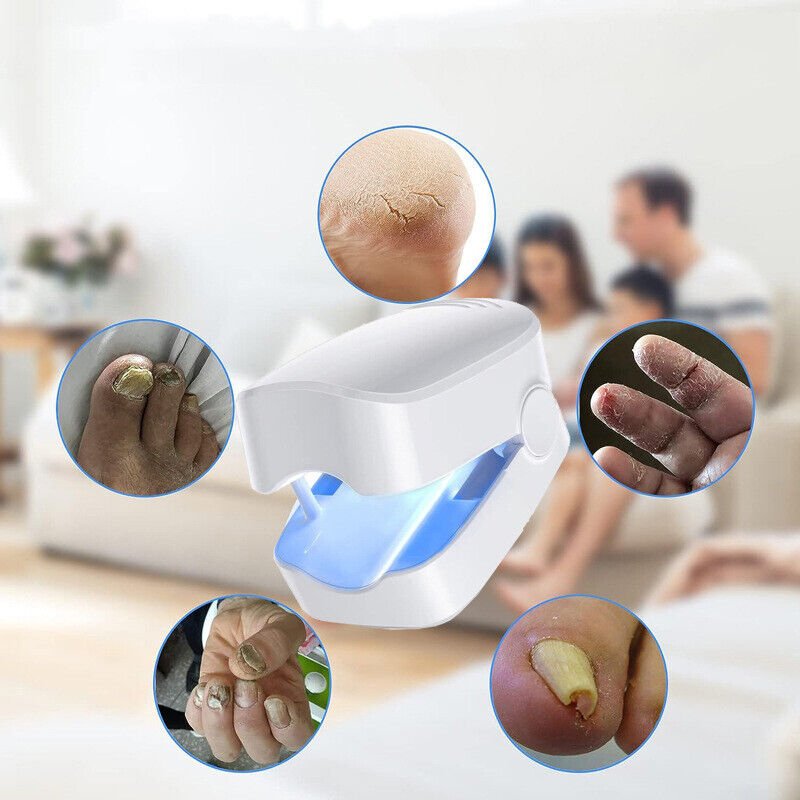 Laser device for nail fungus cleaning – Revolutionary, highly efficient light therapy device from Expert for toe nail conditions