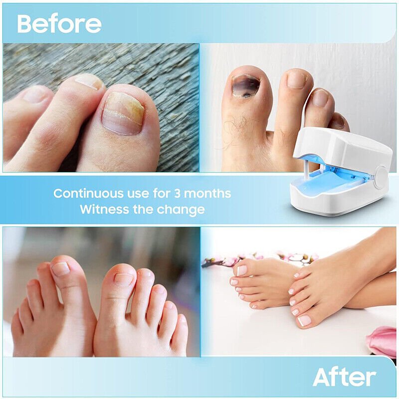 Laser device for nail fungus cleaning – Revolutionary, highly efficient light therapy device from Expert for toe nail conditions