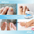 Laser device for nail fungus cleaning – Revolutionary, highly efficient light therapy device from Expert for toenail diseases