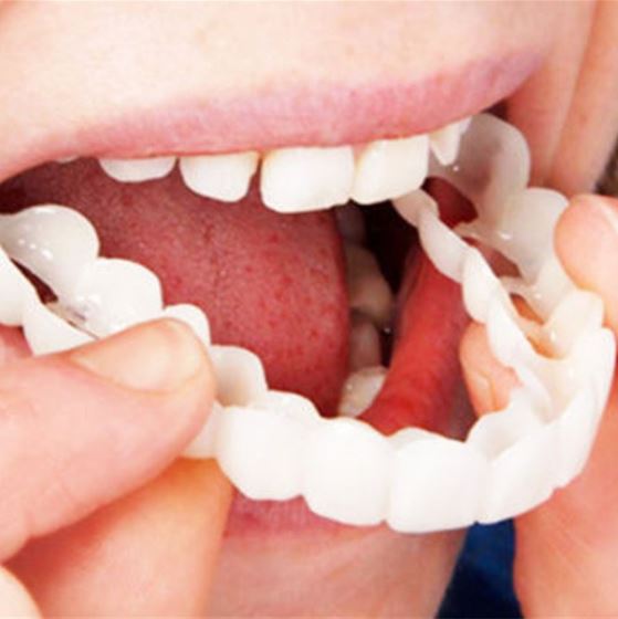 SmileSnap - Always the perfect smile with these veneers